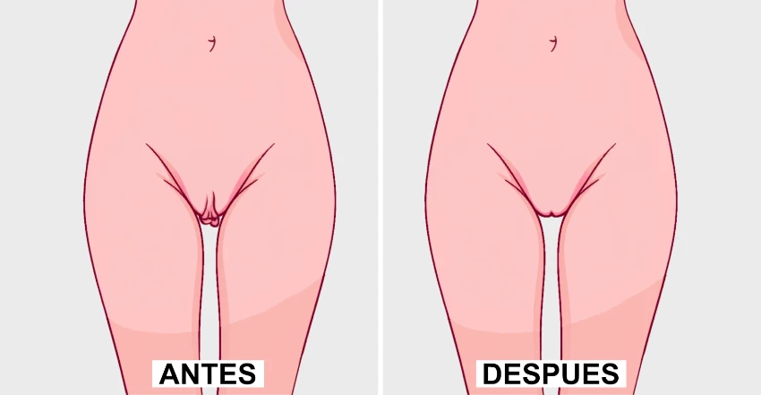 Labioplastia Estilo Barbie - Ilustración Antes y Después