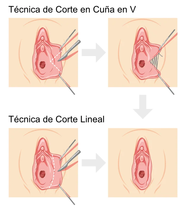Técnicas de Labioplastia - Corte Lineal y Cuña en V