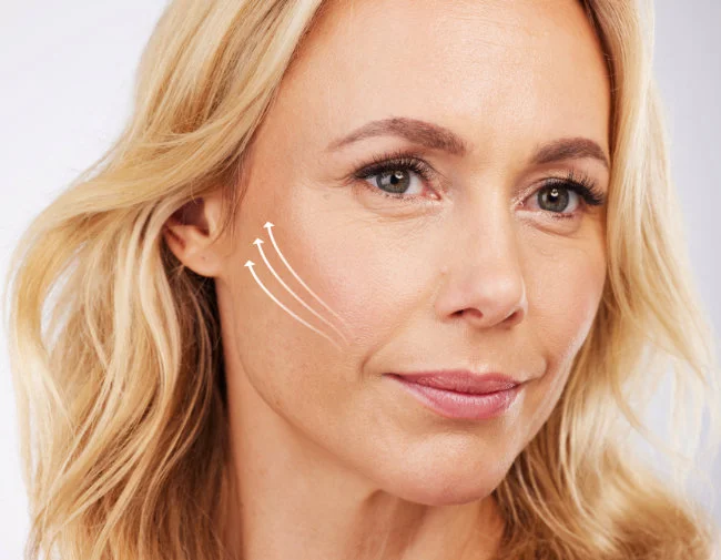 Lifting de Tercio Medio Facial en Dallas, TX - Lifting de Mejillas