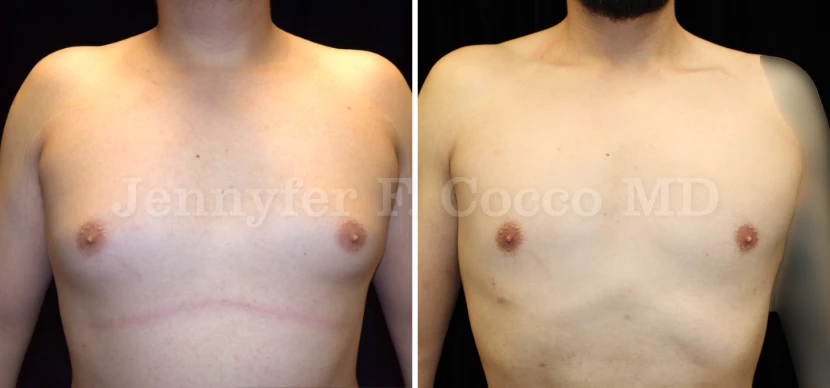 Male Breast Reduction in Dallas, TX - Case E - Front