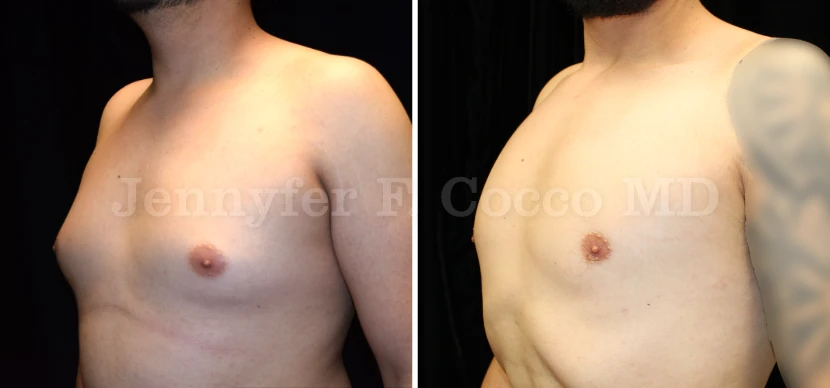 Male Breast Reduction in Dallas, TX - Case E - Left Oblique