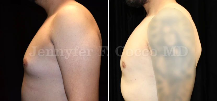 Male Breast Reduction in Dallas, TX - Case E - Left