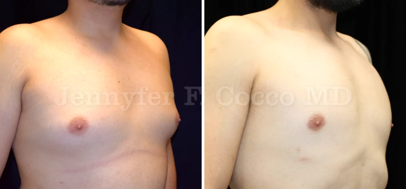 Male Breast Reduction in Dallas, TX - Case E - Right Oblique