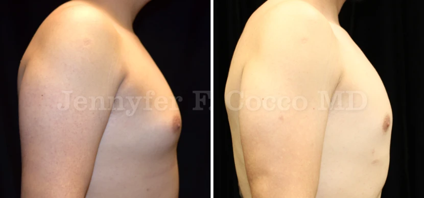 Male Breast Reduction in Dallas, TX - Case E - Right