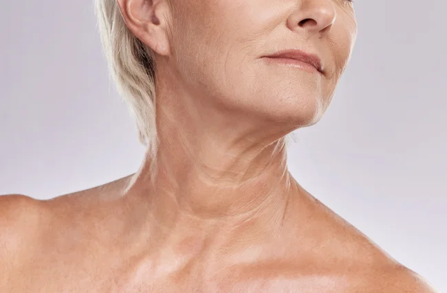 Neck Liposuction combined with platysmaplasty
