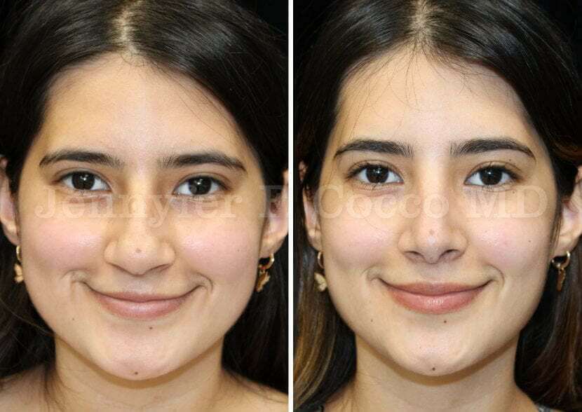 Rhinoplasty in Dallas, TX Nose Job Nose Surgery