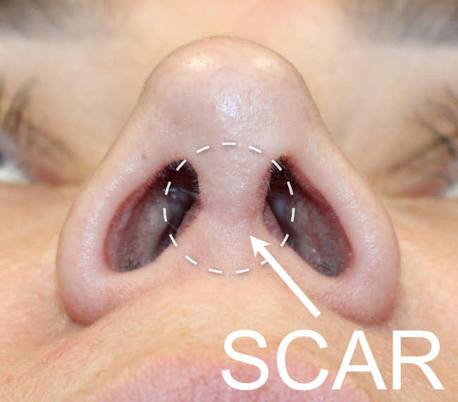 Open Rhinoplasty Scar