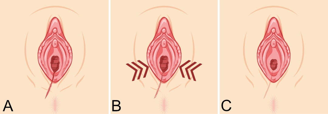 Perineoplastia - Ilustración de los pasos