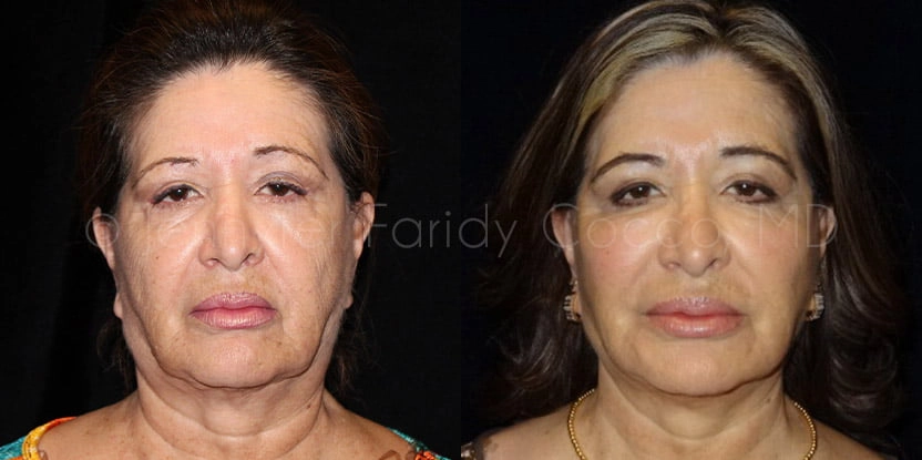 Rhytidectomy in Dallas, TX - Case B - Frontal View
