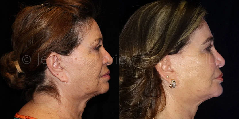 Rhytidectomy in Dallas, TX - Case B - Right Side