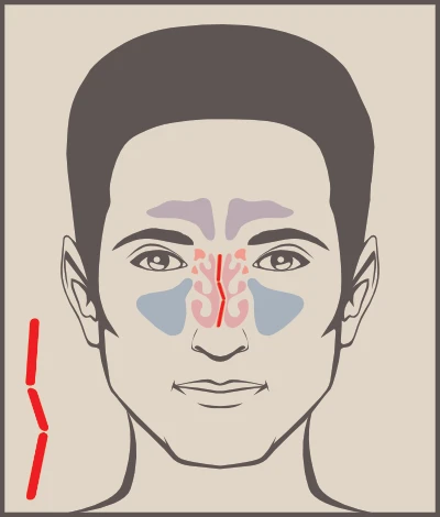 Different Types of Nose Surgery to Breathe Better - Septoplasty corrects a deviated septum