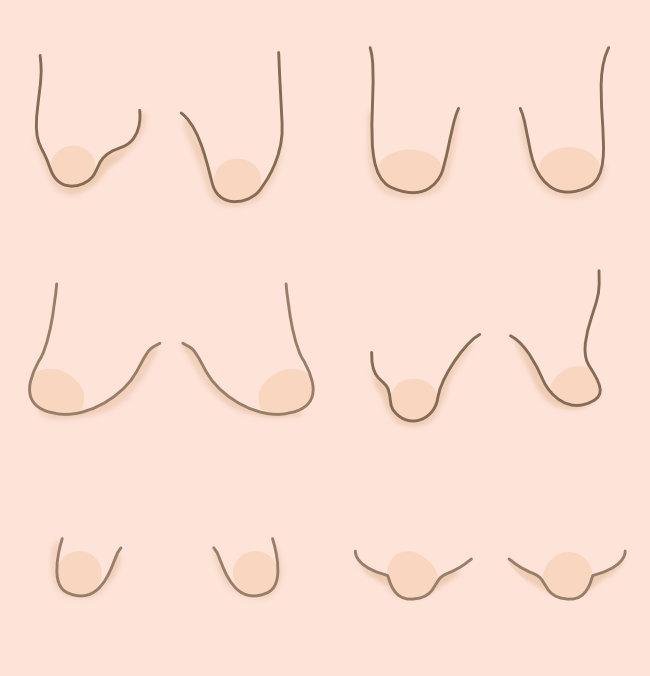 Tipos y Grados de Deformidad de Mamas Tuberosas