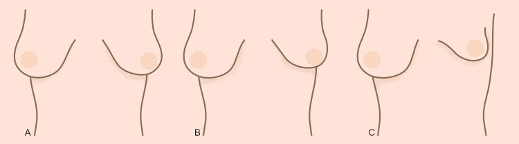 Tuberous Breast Asymmetry Grades - Mild, Moderate and Severe