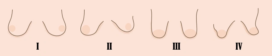 Tuberous Breast Deformity Types from Type I to Type IV