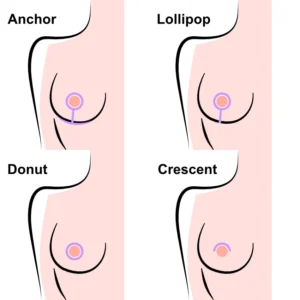 Types of Breast Lift Incisions