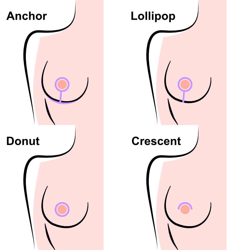 Types of Breast Lift Incisions