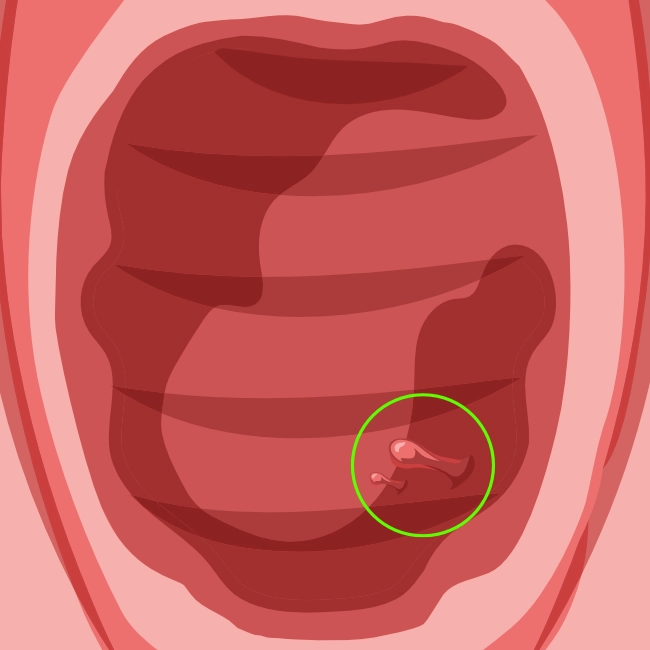 Medical illustration showing vaginal polyps as elongated growths originating from the vaginal wall, distinct from hymenal remnants which are located at the edges of the vaginal opening.