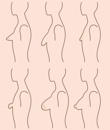 What are tubular breasts? Profiles of different types
